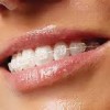 Ortodontia – arta indreptarii dintilor