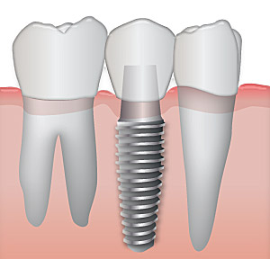 video-implant-dentar
